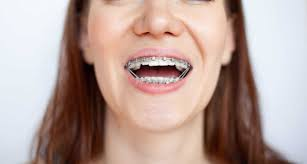 How Clear Braces in Kelowna Help Fix Midline and Jaw Alignment